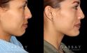 Patient 01 Right Side View Chin implant, Rhinoplasty, BAM Gabbay Plastic Surgery