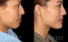 Patient 01 Right Side View Chin implant, Rhinoplasty, BAM Gabbay Plastic Surgery
