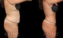 Patient before and after abdominoplasty from multiple angles. Not the improvements while standing and seated, removing the effect of bunching skin and stomach fat, and restoring a flat tightness to the area.