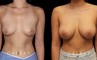 Female patient in her 20s before-and-after revision breast augmentation, including implant removal and replacement with additional breast lift to improve breast position.