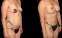 Before and after a mommy makeover consisting of abdominoplasty, breast augmentation, and a breast lift. Using targeted liposuction, created a smoother abdominal contour while also repositioning the breasts with a lift combined with augmentation for improved size and shape.The breast lift also moved the nipples to a higher, symmetrical point. Patient recovery was smooth without complications.