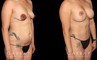Before and after a mommy makeover consisting of abdominoplasty, breast augmentation, and a breast lift. Using targeted liposuction, created a smoother abdominal contour while also repositioning the breasts with a lift combined with augmentation for improved size and shape.The breast lift also moved the nipples to a higher, symmetrical point. Patient recovery was smooth without complications.