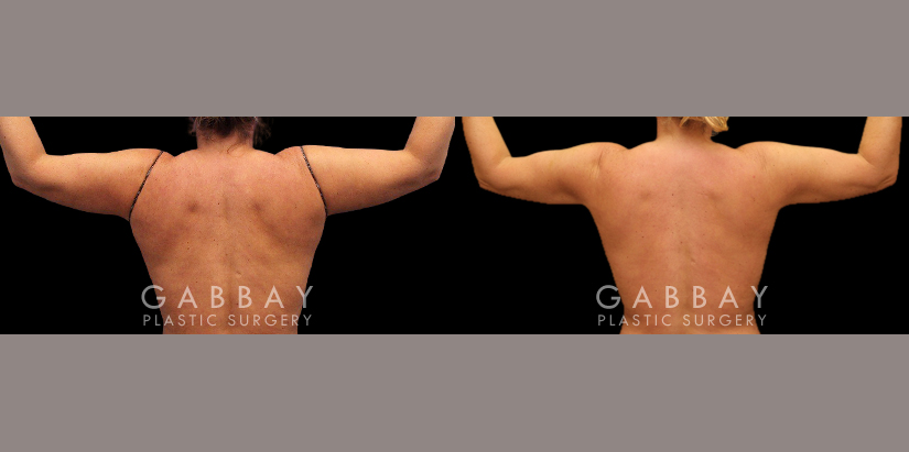 Procedures Depicted:  Lipo Arms and back bra roll