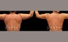 Procedures Depicted:  Lipo Arms and back bra roll