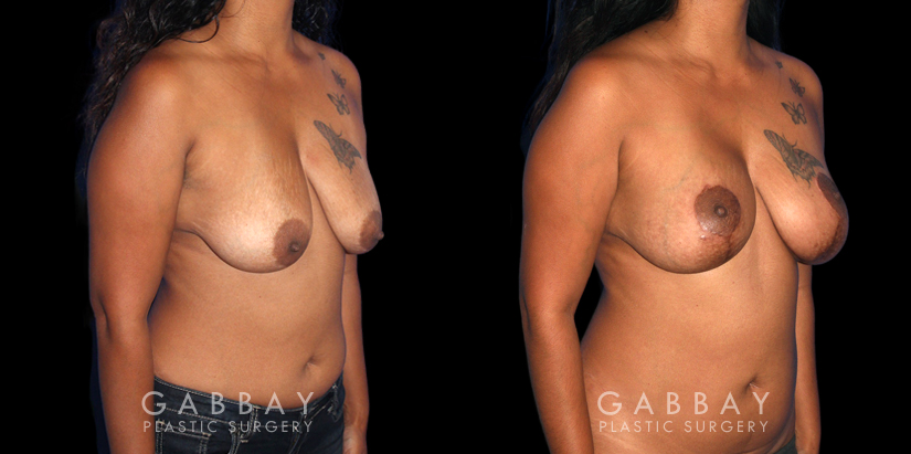 Procedures Depicted:  Wise Mastopexy with Silicone Breast Implants