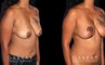 Procedures Depicted:  Wise Mastopexy with Silicone Breast Implants