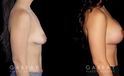 Procedures Depicted:  Breast Augmentation w/ Mastopexy – Silicone