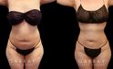 Before and after surgical liposuction for the abdomen, removing stubborn fat with minimal use of invasive techniques. Note the visible belly fat reduction for a smoother contour.