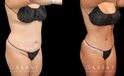 Patient before and after abdominoplasty from multiple angles. Not the improvements while standing and seated, removing the effect of bunching skin and stomach fat, and restoring a flat tightness to the area.
