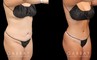 Patient before and after abdominoplasty from multiple angles. Not the improvements while standing and seated, removing the effect of bunching skin and stomach fat, and restoring a flat tightness to the area.