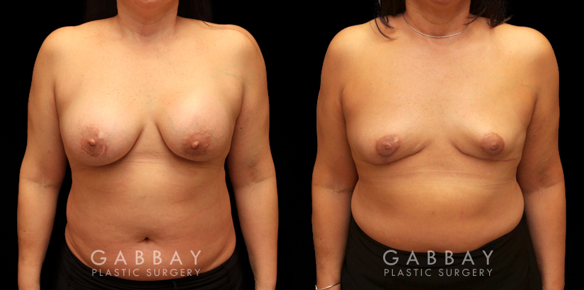 Procedures Depicted:  Auto Augmentation with lift