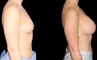 Smoother recovery for patient who chose silicone implants for breast augmentation. Breast position was maintained to keep a natural look that enhances her body type’s contours.