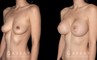 Saline breast augmentation results. Note how the breasts increased several cup sizes in volume while still balancing with the patient’s natural body shape. Breast slope is mild with impression protrusion in the silhouette.