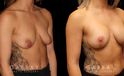 Procedures Depicted:  Mastopexy with Breast Augmentation