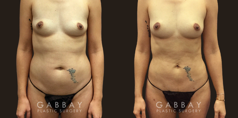 Procedures Depicted:  Breast Augmentation – Silicone Patient sought to remove final stubborn pockets of belly fat, restoring a more youthful figure and enhancing her natural figure.