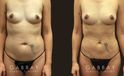 Procedures Depicted:  Breast Augmentation – Silicone Patient sought to remove final stubborn pockets of belly fat, restoring a more youthful figure and enhancing her natural figure.