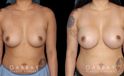 Following a smooth recovery, the patient’s silicone implants settle well to produce a round breast shape with increased volume. The breasts sit comfortable without the position being altered.