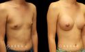 Patient results from breast augmentation, showing the increase from minimal breast size to a round, fuller appearance that suits her body shape.