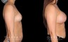 Silicone breast implants after full recovery. Patient increased breasts by several cup sizes without stretching out the skin, maintaining a round alluring shape with boosted volume.