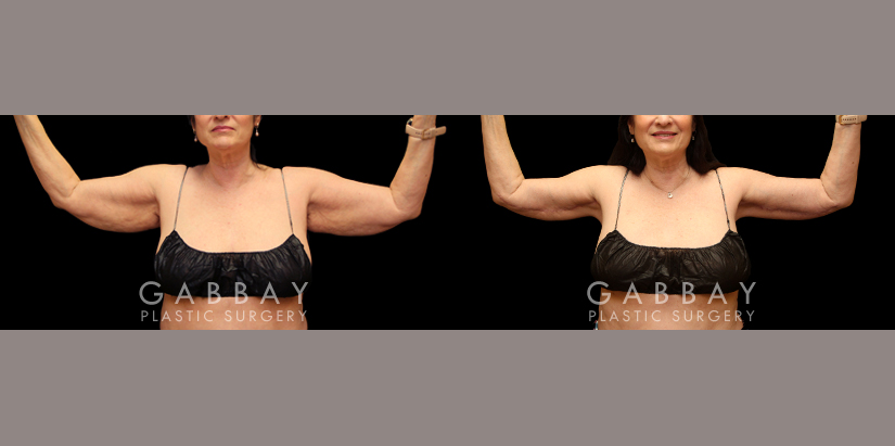 Procedures Depicted:  Arm lift with lipo