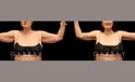 Procedures Depicted:  Arm lift with lipo