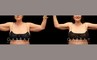 Procedures Depicted:  Arm lift with lipo