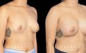 Silicone breast augmentation results, with patient having notable increase in breast volume and protrusion. But the breasts still maintain a balance between them.
