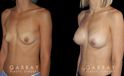 Using silicone implants, the patient saw increased breast volume while maintaining a comfortable, proportionate size. Nipple position and overall breast aesthetic was maintained while increasing size.
