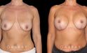 Procedures Depicted:  Wise Mastopexy with Silicone Breast Implants