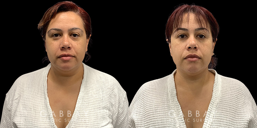 Patient 12 Front View Lipo Neck Gabbay Plastic Surgery