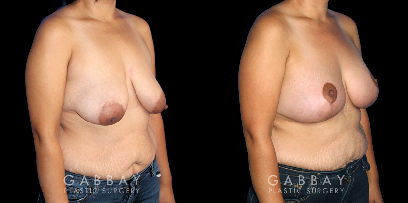 Procedures Depicted:  Breast Augmentation – Silicone, Mastopexy