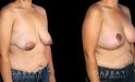 Procedures Depicted:  Breast Augmentation – Silicone, Mastopexy