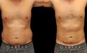 Late 30s male patient before and after male liposuction. Targeted fat removal resulted in a flatter abdomen and significant reduction of flank volume. Note the reduction of waist curves for a straighter silhouette.