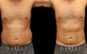 Late 30s male patient before and after male liposuction. Targeted fat removal resulted in a flatter abdomen and significant reduction of flank volume. Note the reduction of waist curves for a straighter silhouette.