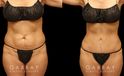 Before and after combined tummy tuck and liposuction of the abdomen, back bra roll, and waist. This 360-degree approach resulting in a balanced outcome, slimmed profile, and fitter looking contour. The patient recovered smoothly from the multi-procedure surgery and healed on schedule.