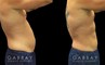 Male patient after abdominal liposuction, improving the patient’s torso shape and resulting in a more masculine contour from each angle with a flat abdomen. Compare to the sloping belly roundness before.