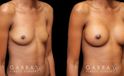 Patient before-and-after photos for breast augmentation with silicone implants. Patient increased cup size while maintaining a natural, balanced look to the breasts.