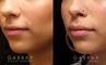 Patient 13 3/4th Left Side View Lip Augmentation Gabbay Plastic Surgery