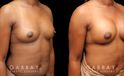 Patient before and after receiving silicone implants to increase breast roundness and overall volume. Results are shown following complete, smoother recovery.
