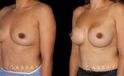 Silicone implants used to increase breast volume while keeping a natural shape. Patient healed well with no complications.