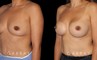Silicone implants used to increase breast volume while keeping a natural shape. Patient healed well with no complications.