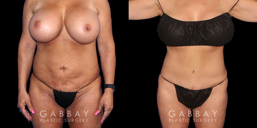 Procedures Depicted:  Abdominoplasty Abdominal tightening (tummy tuck) with liposuction shows a restored youthful figure, smoothing stomach area wrinkles for a more compact and rejuvenated appearance.