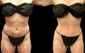 Late 20s female patient with minor stubborn fat wanted to complete her efforts to lose weight. Stomach area liposuction allowed her to achieve a flat abdominal area that looks great from every angle.