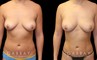 Patient 18 Front View Breast Fat Grafting Gabbay Plastic Surgery