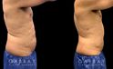 Male liposuction before-and-after photo for 360 lipo showing a result in a slimmer waist and flatter abdominal area for an enhanced torso contour. Flanks are significantly slimmed and present a toned silhouette.