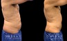 Male liposuction before-and-after photo for 360 lipo showing a result in a slimmer waist and flatter abdominal area for an enhanced torso contour. Flanks are significantly slimmed and present a toned silhouette.