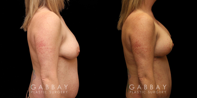 Procedures Depicted:  Breast aug/pexy and tummy tuck