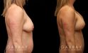 Procedures Depicted:  Breast aug/pexy and tummy tuck