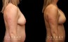 Procedures Depicted:  Breast aug/pexy and tummy tuck