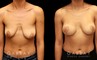 Procedures Depicted:  Breast Augmentation – Silicone & Lift